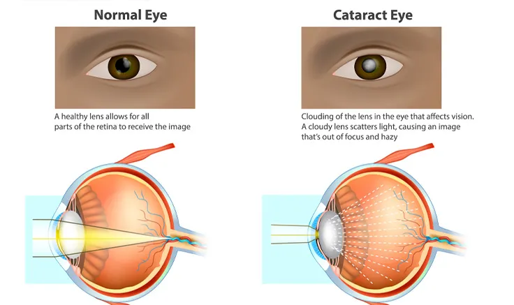 A comparison image of a clear vision and a vision blurred by cataracts.